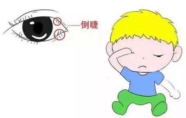 眼睛總有刺痛感？可能是倒睫惹的禍