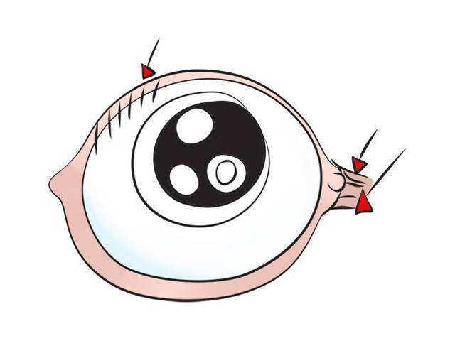 倒睫是什么？有哪些癥狀和危害？