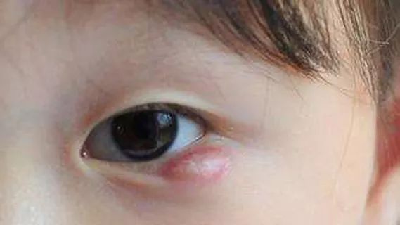 小孩子得了霰粒腫要怎么辦？按摩？熱敷？手術？...